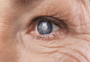 Cataracts: Will it be Possible to Treat Them Without Surgery in the Future? 1