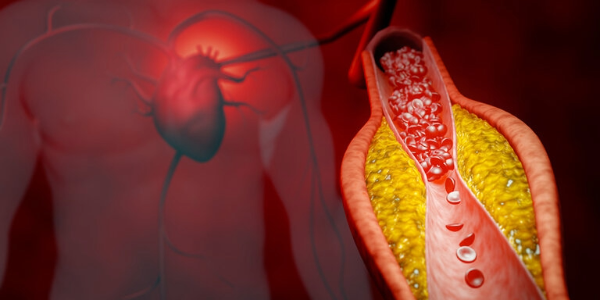 How Cholesterol and Triglyceride Levels are Related to Alzheimer's Disease